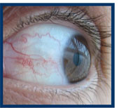 Image of bloodshot eye
