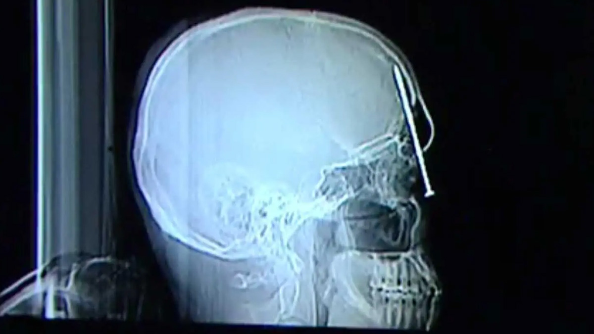 xray of a skull with a nail inside it